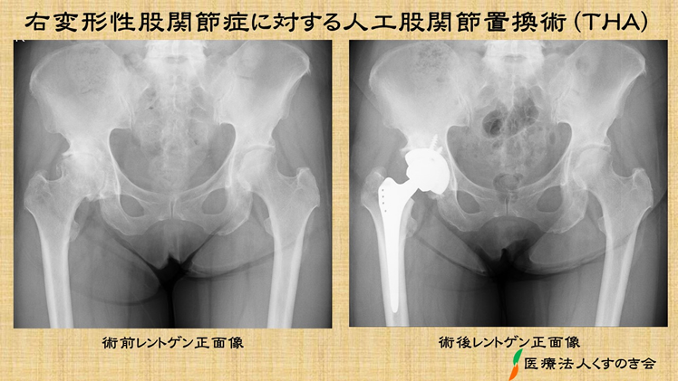 変形性股関節症の評価と治療  ME305-S 楽天市場】変形性股関節症の評価と治療[理学療法 ME305-S 全2巻