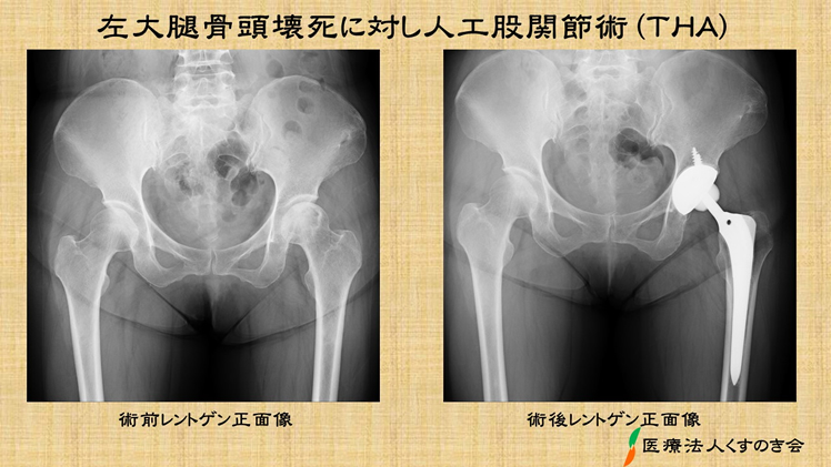 股関節が痛い | 医療法人 くすのき会