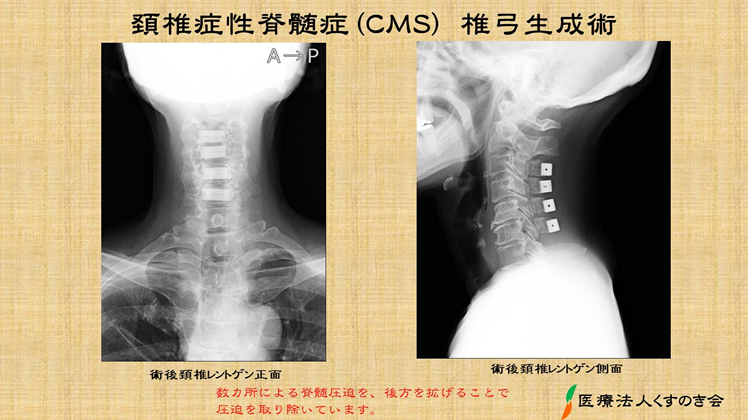 首から肩 うでへの痛み 痺れ 医療法人 くすのき会